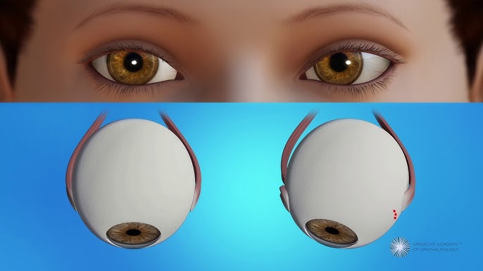 Squint Surgery - Strabismus Correction